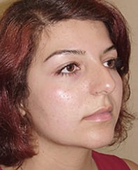 Case--6571 | Before Rhinoplasty