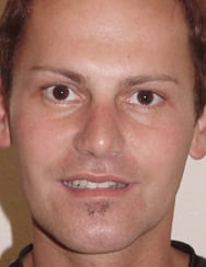 Case--4684 | After Rhinoplasty