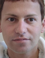 Case--4684 | Before Rhinoplasty