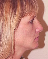 Case--8076 | After Rhinoplasty