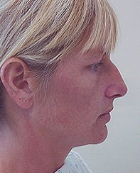 Case--8076 | Before Rhinoplasty