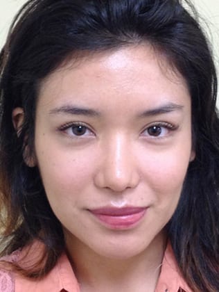 Case--7653 | After Rhinoplasty