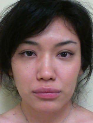 Case--7653 | Before Rhinoplasty