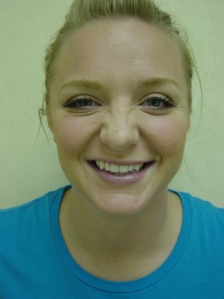 Case--1393 | After Rhinoplasty