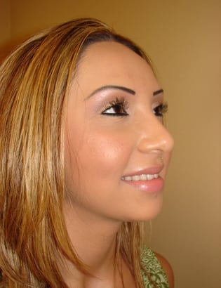 Case--2212 | After Rhinoplasty