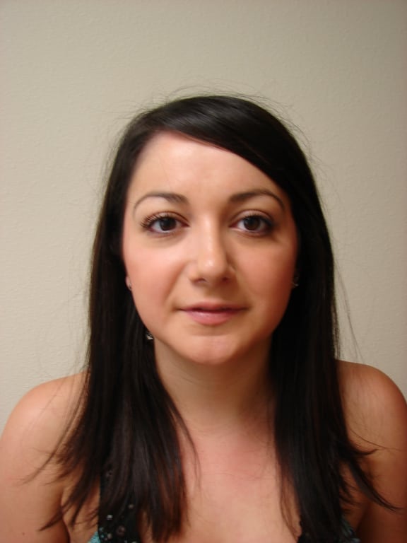 Case--7702 | After Rhinoplasty