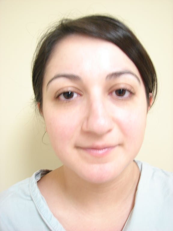 Case--7702 | Before Rhinoplasty