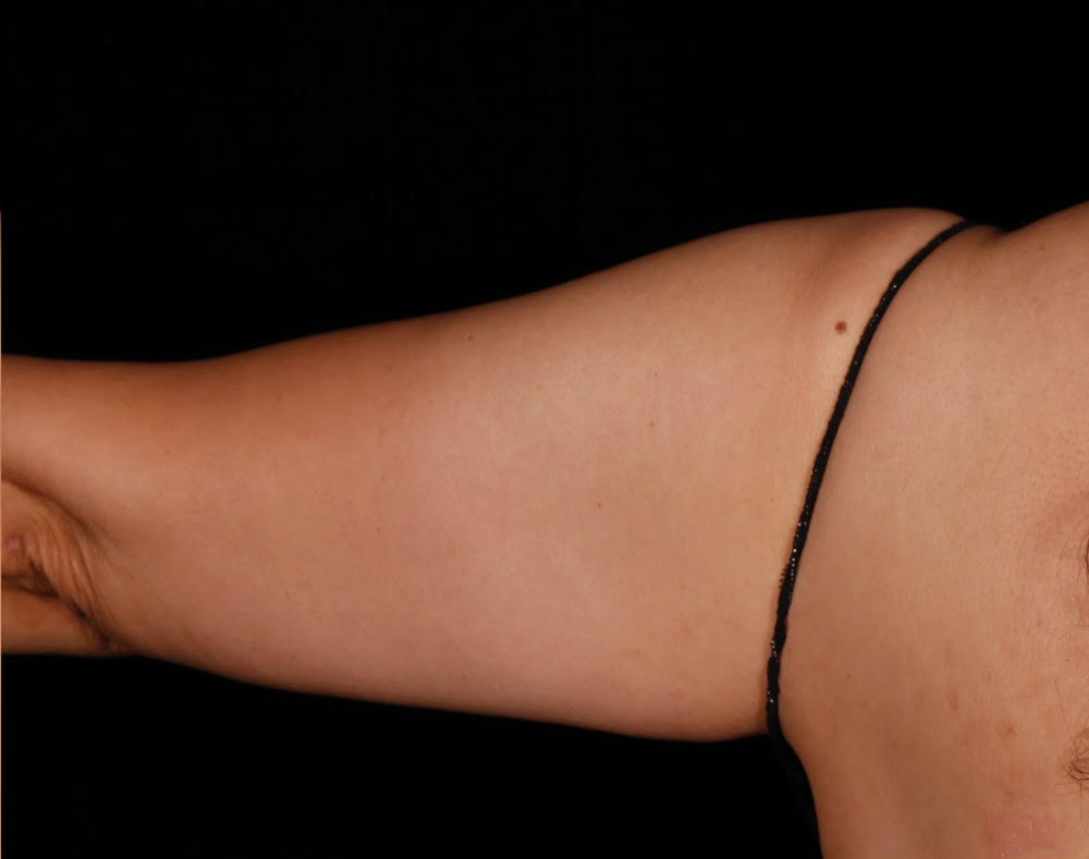 Case--2699 | After Body