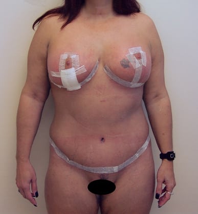 Case--3715 | After Tummy Tuck