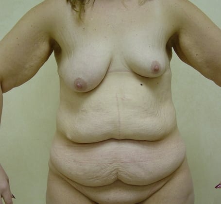 Case--7067 | Before Tummy Tuck