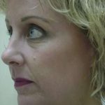 Laser Resurfacing Before & After Patient #125