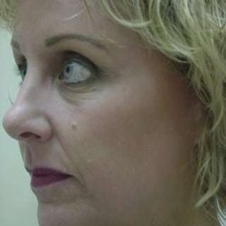 Laser Resurfacing Before & After Patient #125