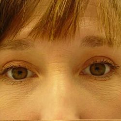 Blepharoplasty Before & After Patient #482
