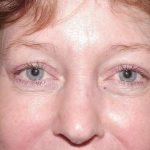 Blepharoplasty Before & After Patient #486