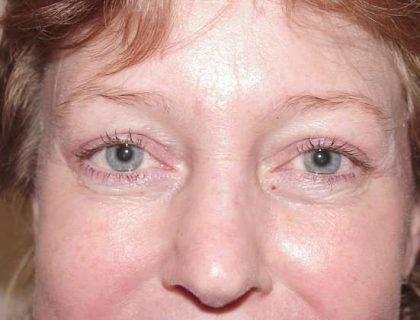 Blepharoplasty Before & After Patient #486