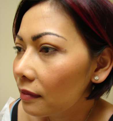 Blepharoplasty Before & After Patient #489