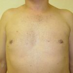 Gynecomastia Before & After Patient #492