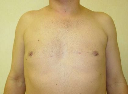 Gynecomastia Before & After Patient #492