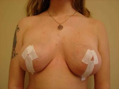 Breast Reduction Before & After Patient #499