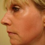 Laser Resurfacing Before & After Patient #158