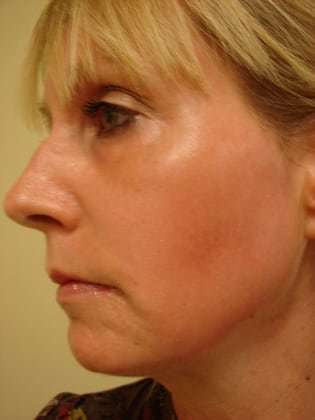 Laser Resurfacing Before & After Patient #158