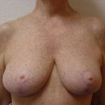 Breast Reduction Before & After Patient #522