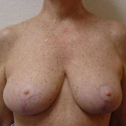 Breast Reduction Before & After Patient #522