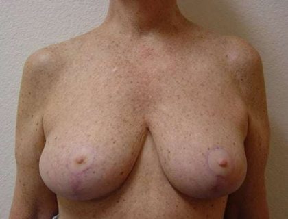 Breast Reduction Before & After Patient #522