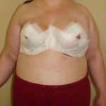 Breast Reduction Before & After Patient #525