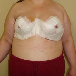 Breast Reduction Before & After Patient #525