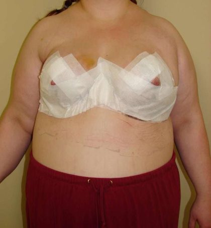 Breast Reduction Before & After Patient #525