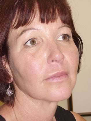 Fillers Before & After Patient #161