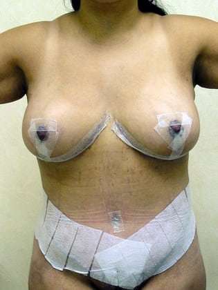 Breast Lift Before & After Patient #561