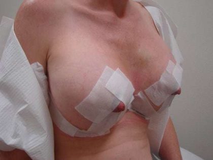 Breast Lift Before & After Patient #588