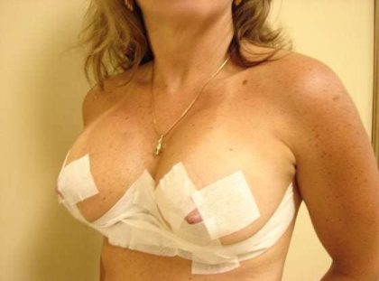 Breast Lift Before & After Patient #596