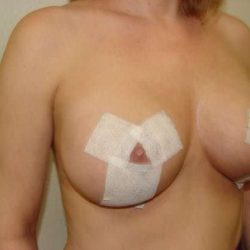 Breast Lift Before & After Patient #599