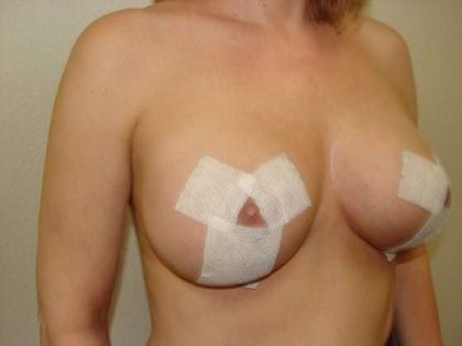 Breast Lift Before & After Patient #599