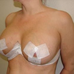 Breast Implants Before & After Patient #610