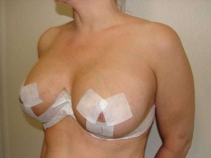 Breast Implants Before & After Patient #610