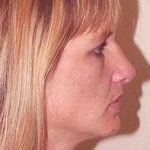 Rhinoplasty Before & After Patient #167