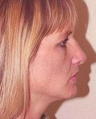 Rhinoplasty Before & After Patient #167