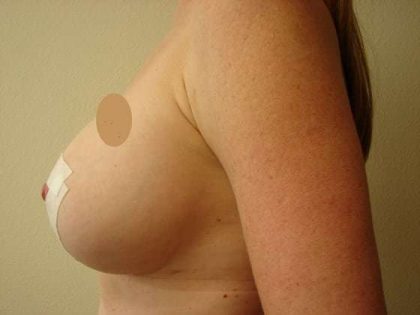 Breast Implants Before & After Patient #635