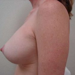 Breast Implants Before & After Patient #655