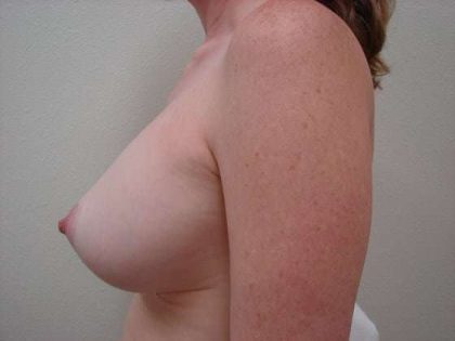 Breast Implants Before & After Patient #655