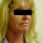 Laser Resurfacing Before & After Patient #121