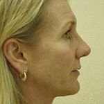 Rhinoplasty Before & After Patient #178