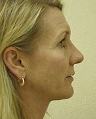 Rhinoplasty Before & After Patient #178