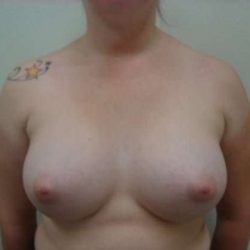 Breast Augmentation Before & After Patient #768