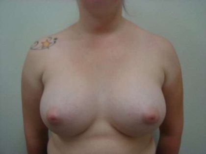Breast Augmentation Before & After Patient #768