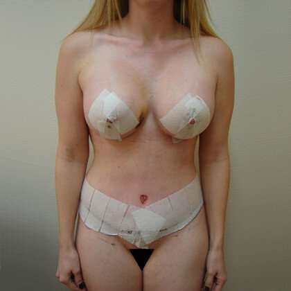 Tummy Tuck Before & After Patient #831
